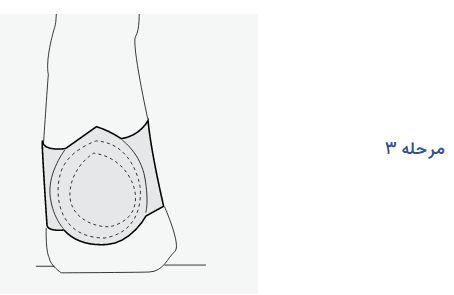 metatarsal-pad-steps-3